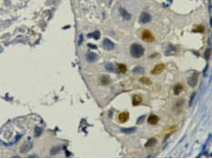 IHC staining of Human breast cancer tissue paraffin-embedded, diluted at 1:200