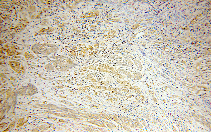 Immunohistochemical of paraffin-embedded human endometrial cancer using Catalog No:109165(CDK6 antibody) at dilution of 1:50 (under 10x lens)