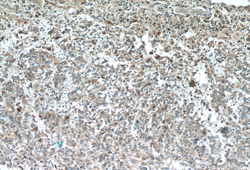 Immunohistochemistry of paraffin-embedded human gliomas tissue slide using Catalog No:115544(SPARCL1 Antibody) at dilution of 1:50 (under 10x lens)