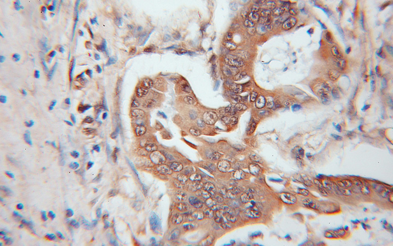 Immunohistochemical of paraffin-embedded human colon cancer using Catalog No:116673(UCHL5 antibody) at dilution of 1:100 (under 10x lens)
