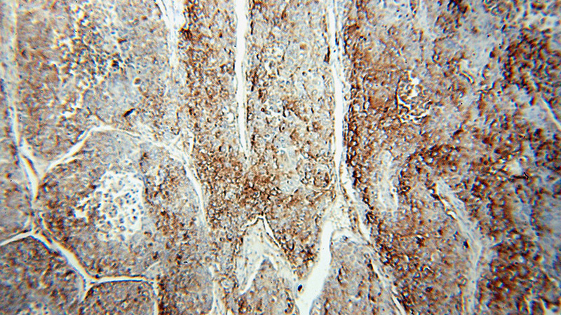 Immunohistochemical of paraffin-embedded human liver cancer using Catalog No:111457(HPSE antibody) at dilution of 1:50 (under 10x lens)