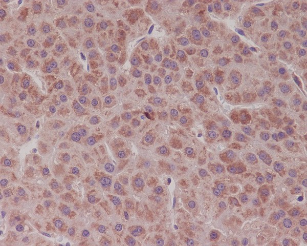Immunohistochemical analysis of paraffin-embedded human liver cancer, using Bcl-XL Antibody.
