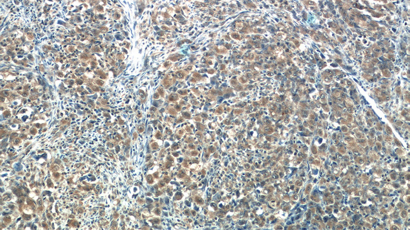 Immunohistochemistry of paraffin-embedded human lymphoma tissue slide using Catalog No:114738(RNF125 Antibody) at dilution of 1:50 (under 10x lens)