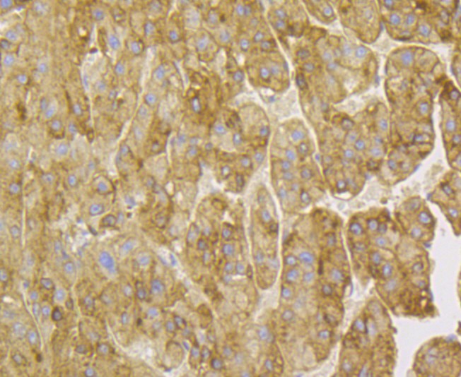Fig2: Immunohistochemical analysis of paraffin-embedded human liver tissue using anti-Kininogen 1 antibody. The section was pre-treated using heat mediated antigen retrieval with Tris-EDTA buffer (pH 8.0-8.4) for 20 minutes. The tissues were blocked in 5% BSA for 30 minutes at room temperature, washed with ddH2O and PBS, and then probed with the antibody at 1/100 dilution, for 30 minutes at room temperature and detected using an HRP conjugated compact polymer system. DAB was used as the chrogen. Counter stained with hematoxylin and mounted with DPX.