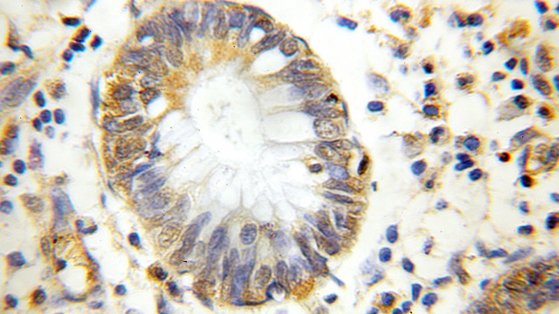 Immunohistochemical of paraffin-embedded human colon cancer using Catalog No:110862(GANP antibody) at dilution of 1:10 (under 10x lens)