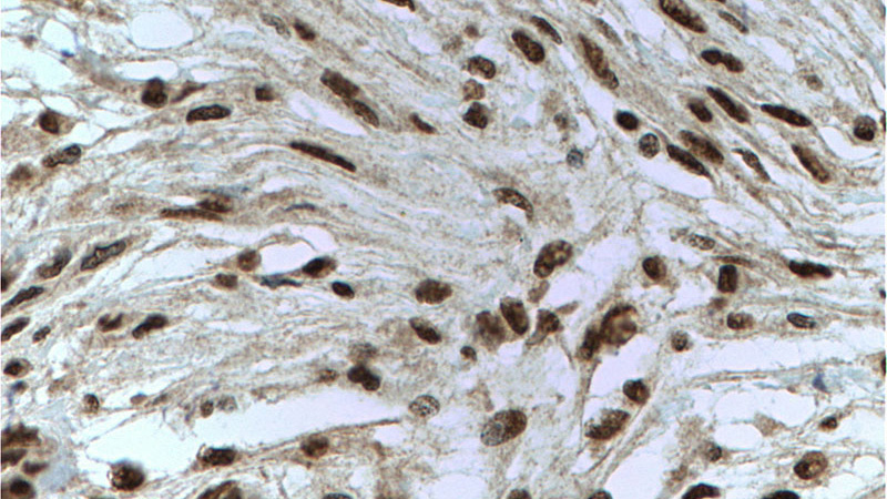 Immunohistochemistry of paraffin-embedded human meningioma tissue slide using Catalog No:107424(MGEA5 Antibody) at dilution of 1:200 (under 40x lens). Heat mediated antigen retrieved with Citric acid buffer, pH6.0.