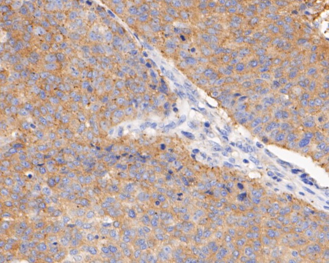 Fig4: Immunohistochemical analysis of paraffin-embedded human lung carcinoma tissue using anti-BCL2L12 antibody. The section was pre-treated using heat mediated antigen retrieval with sodium citrate buffer (pH 6.0) for 20 minutes. The tissues were blocked in 5% BSA for 30 minutes at room temperature, washed with ddH2O and PBS, and then probed with the primary antibody ( 1/400) for 30 minutes at room temperature. The detection was performed using an HRP conjugated compact polymer system. DAB was used as the chromogen. Tissues were counterstained with hematoxylin and mounted with DPX.