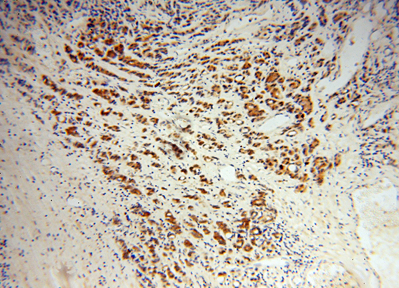Immunohistochemical of paraffin-embedded human gliomas using Catalog No:113729(PEX19 antibody) at dilution of 1:100 (under 10x lens)