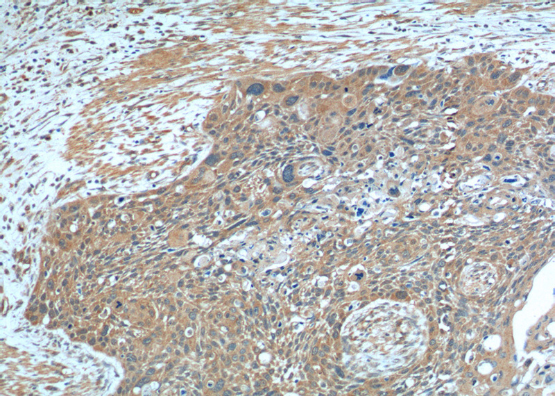 Immunohistochemistry of paraffin-embedded human oesophagus cancer tissue slide using Catalog No:116736(KDR Antibody) at dilution of 1:200 (under 10x lens).