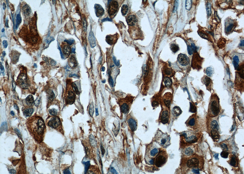 Immunohistochemical of paraffin-embedded human breast cancer using Catalog No:107056(ANXA2 antibody) at dilution of 1:50 (under 40x lens)