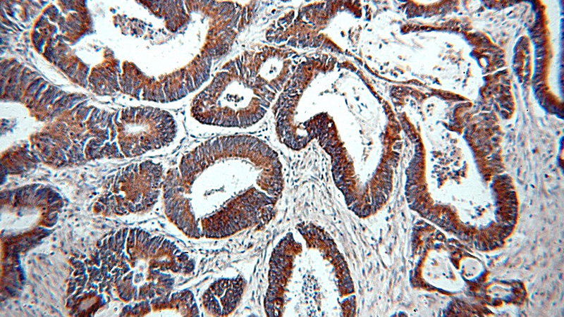 Immunohistochemical of paraffin-embedded human colon cancer using Catalog No:114387(PSMB7 antibody) at dilution of 1:50 (under 10x lens)