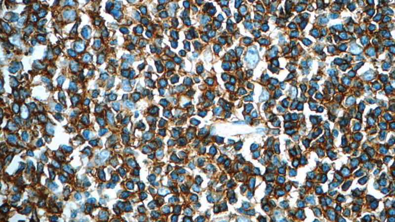 Immunohistochemistry of paraffin-embedded human tonsillitis slide using Catalog No:109005(MS4A1,CD20 Antibody) at dilution of 1:50