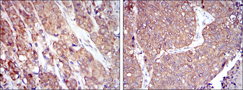 Immunohistochemical analysis of paraffin-embedded prostate cancer tissues (left) and lung cancer tissues (right) using HSP90AB1 mouse mAb with DAB staining.
