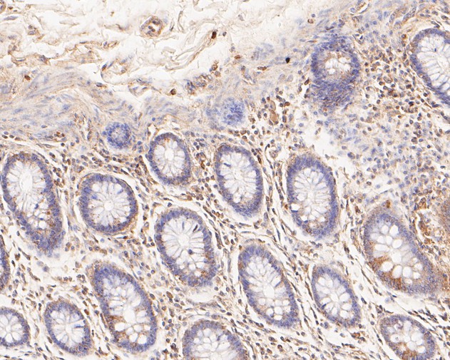 Fig4:; Immunohistochemical analysis of paraffin-embedded human colon carcinoma tissue using anti-TREM2 antibody. The section was pre-treated using heat mediated antigen retrieval with Tris-EDTA buffer (pH 8.0-8.4) for 20 minutes.The tissues were blocked in 5% BSA for 30 minutes at room temperature, washed with ddH; 2; O and PBS, and then probed with the primary antibody ( 1/50) for 30 minutes at room temperature. The detection was performed using an HRP conjugated compact polymer system. DAB was used as the chromogen. Tissues were counterstained with hematoxylin and mounted with DPX.