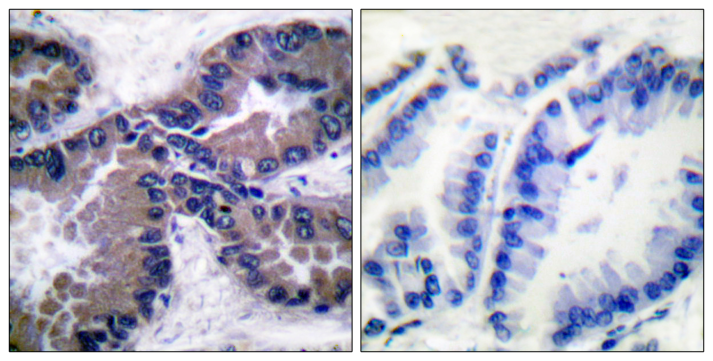 Immunohistochemistry analysis of paraffin-embedded human lung carcinoma tissue, using Nrf2 Antibody. The picture on the right is blocked with the synthesized peptide.
