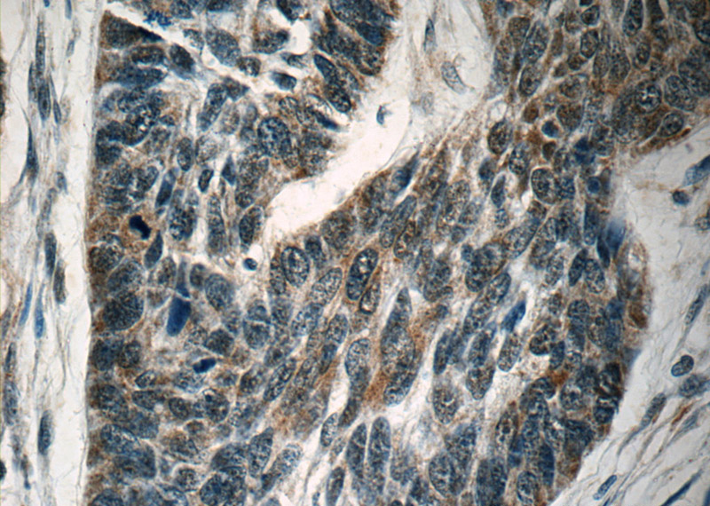 Immunohistochemistry of paraffin-embedded human skin cancer tissue slide using Catalog No:115539(SPANXA2 Antibody) at dilution of 1:50