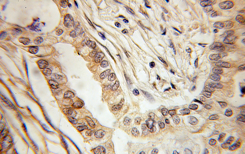 Immunohistochemical of paraffin-embedded human lung cancer using Catalog No:113197(KLRC1 antibody) at dilution of 1:100 (under 10x lens)