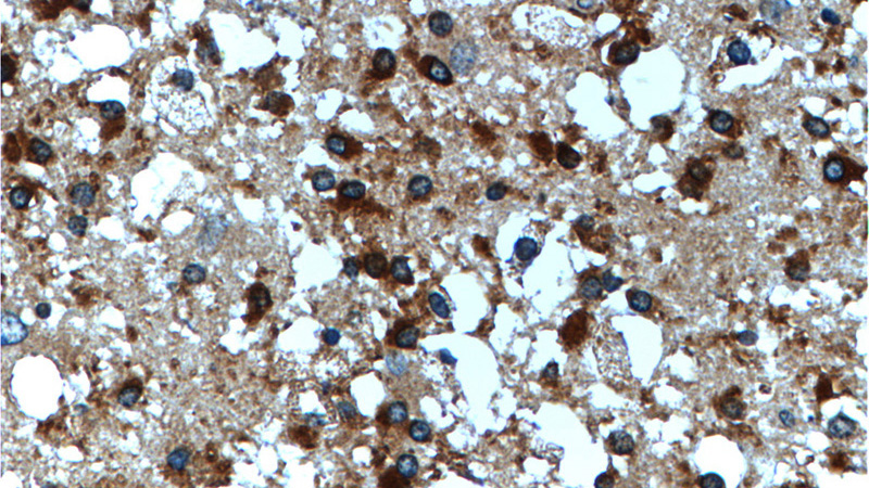 Immunohistochemistry of paraffin-embedded human gliomas tissue slide using Catalog No:117113(BDNF Antibody) at dilution of 1:200 (under 40x lens).