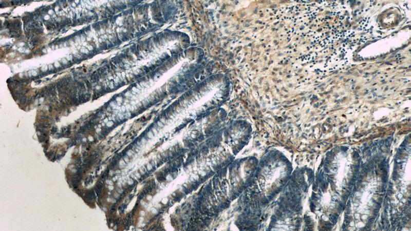 Immunohistochemistry of paraffin-embedded human colon slide using Catalog No:116018(TGFA Antibody) at dilution of 1:50