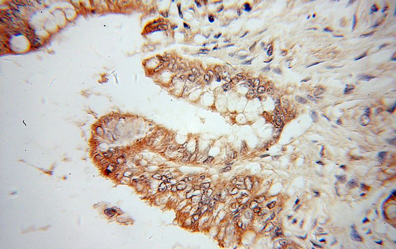 Immunohistochemical of paraffin-embedded human colon cancer using Catalog No:109194(CES3 antibody) at dilution of 1:100 (under 40x lens)