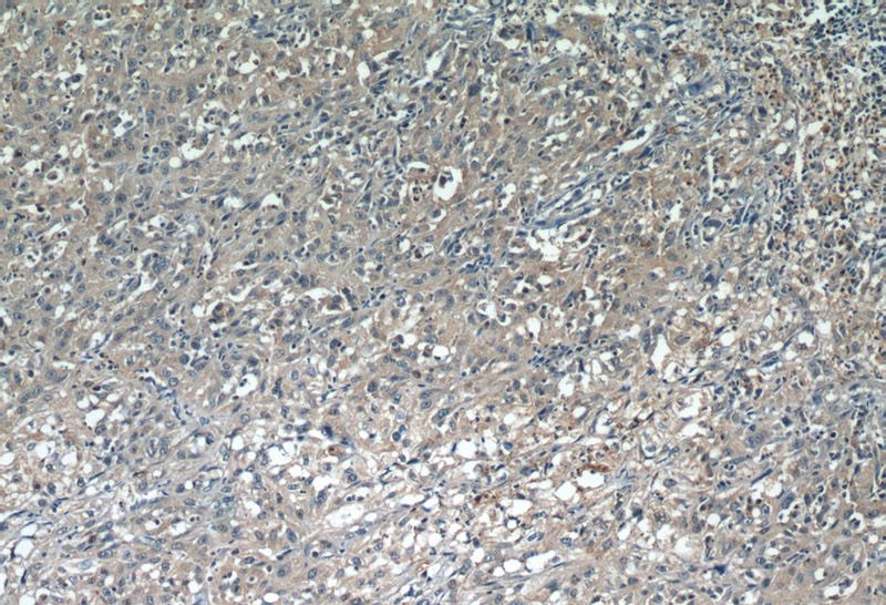 Immunohistochemistry of paraffin-embedded human cervical cancer tissue slide using Catalog No:109114(CDCA3 Antibody) at dilution of 1:50 (under 10x lens)