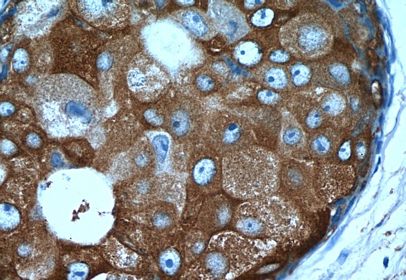 Immunohistochemistry of paraffin-embedded human breast cancer tissue slide using Catalog No:115593(SRP54 Antibody) at dilution of 1:50 (under 40x lens)