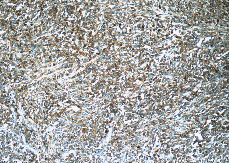 Immunohistochemistry of paraffin-embedded human lymphoma tissue slide using Catalog No:114326(PTPRCAP Antibody) at dilution of 1:50