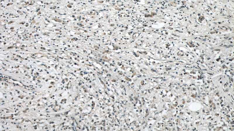 Immunohistochemical of paraffin-embedded human breast cancer using Catalog No:107063(APOBEC3G antibody) at dilution of 1:50 (under 10x lens)