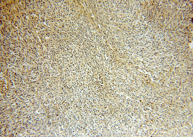 Immunohistochemical of paraffin-embedded human lymphoma using Catalog No:111841(IRF8 antibody) at dilution of 1:100 (under 10x lens)