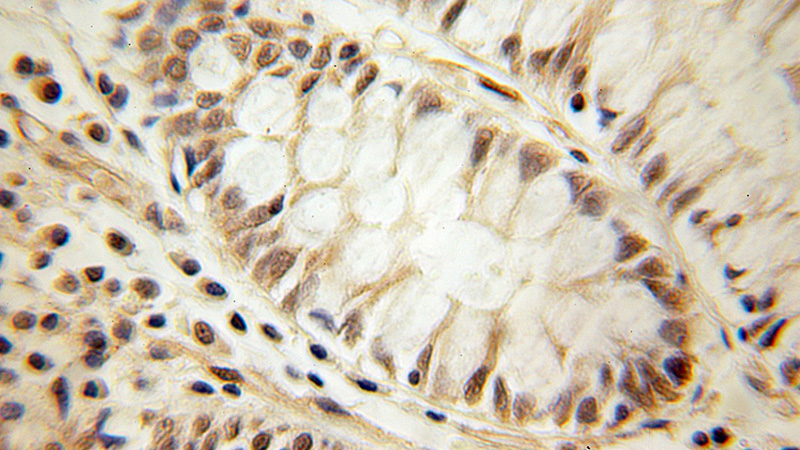 Immunohistochemical of paraffin-embedded human colon cancer using Catalog No:109821(DDX21 antibody) at dilution of 1:100 (under 10x lens)