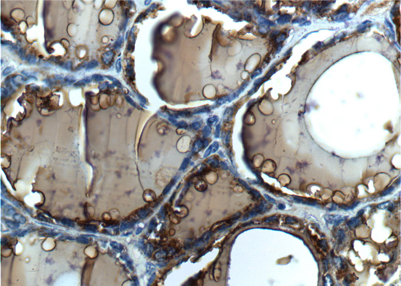 Immunohistochemistry of paraffin-embedded human thyroid tissue slide using Catalog No:116117(TG Antibody) at dilution of 1:200 (under 40x lens).