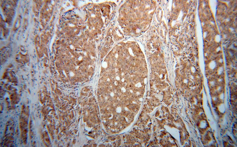 Immunohistochemical of paraffin-embedded human prostate cancer using Catalog No:111302(HEXA antibody) at dilution of 1:50 (under 10x lens)