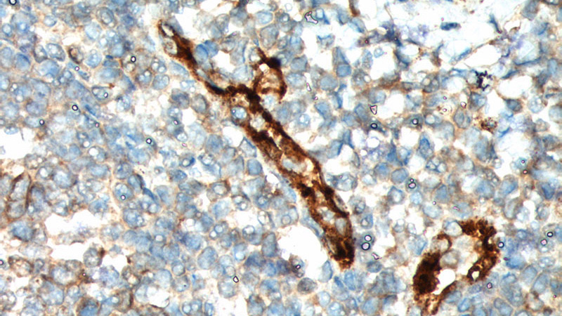 Immunohistochemistry of paraffin-embedded human tonsillitis tissue slide using Catalog No:116811(VWF, VWFpp Antibody) at dilution of 1:200 (under 40x lens).
