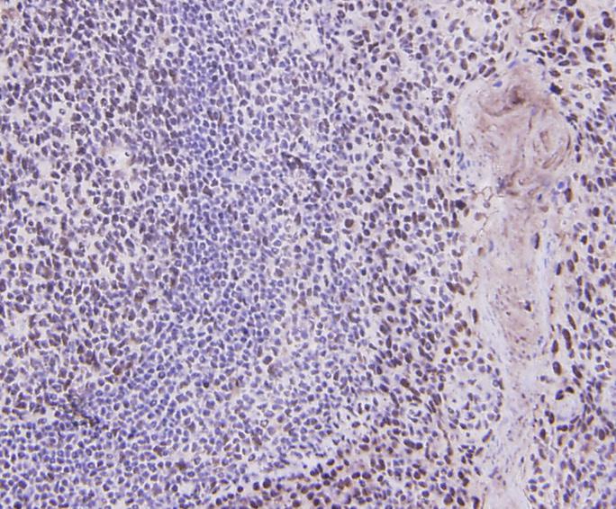 Fig2: Immunohistochemical analysis of paraffin-embedded human tonsil tissue using anti-Cyclin D1 antibody. Counter stained with hematoxylin.