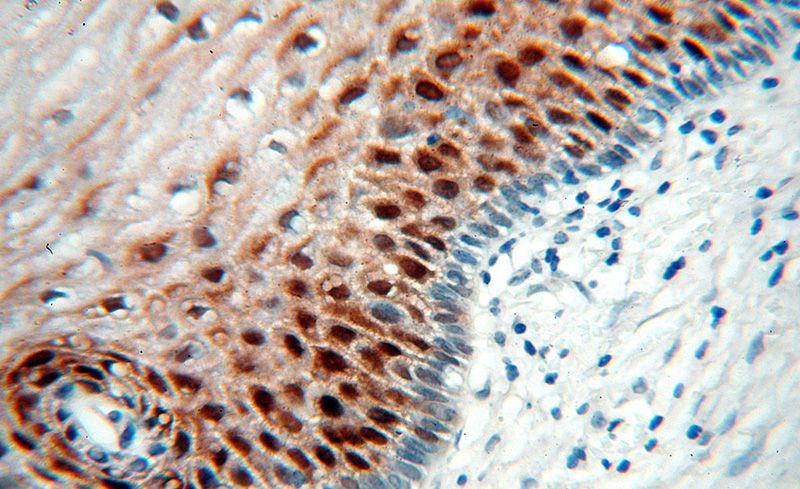 Immunohistochemical of paraffin-embedded human cervix using Catalog No:110841(Galectin-7 antibody) at dilution of 1:100 (under 40x lens)