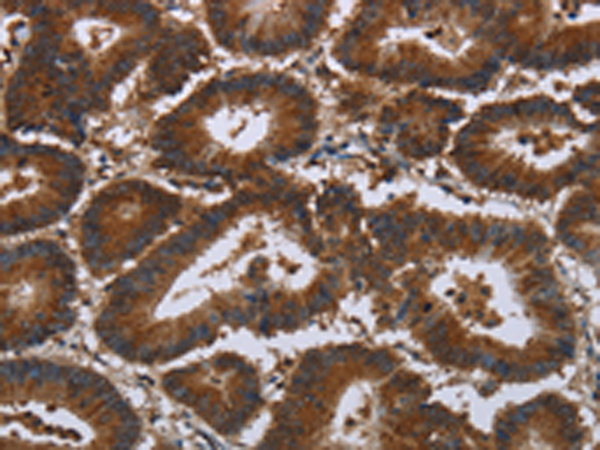 The image is immunohistochemistry of paraffin-embedded Human colon cancer tissue using 166813(CERS5 Antibody) at dilution 1/35, on the right is treated with synthetic peptide. (Original magnification: ×200)