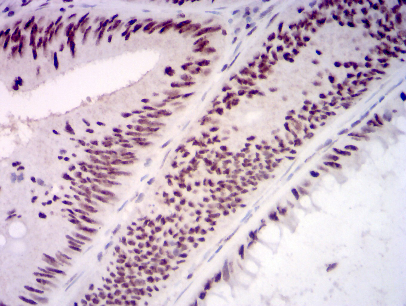 Fig4: Immunohistochemical analysis of paraffin-embedded rectum cancer tissues using anti-KMT2D antibody. The section was pre-treated using heat mediated antigen retrieval with Tris-EDTA buffer (pH 8.0) for 20 minutes. The tissues were blocked in 5% BSA for 30 minutes at room temperature, washed with ddH2O and PBS, and then probed with the primary antibody ( 1/100) for 30 minutes at room temperature. The detection was performed using an HRP conjugated compact polymer system. DAB was used as the chromogen. Tissues were counterstained with hematoxylin and mounted with DPX.
