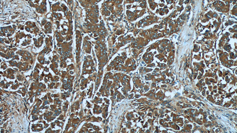 Immunohistochemistry of paraffin-embedded human liver cancer tissue slide using Catalog No:112364(MACC1 Antibody) at dilution of 1:50 (under 10x lens)
