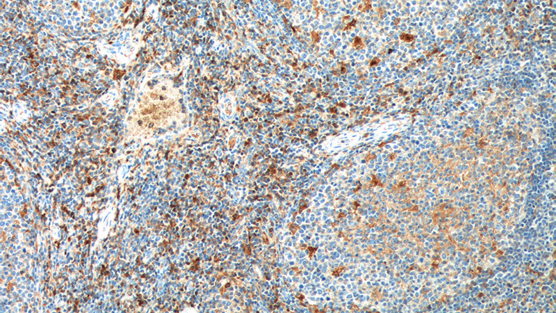 Immunohistochemistry of paraffin-embedded human tonsillitis tissue slide using Catalog No:109129(CD52 Antibody) at dilution of 1:200 (under 10x lens). heat mediated antigen retrieved with Tris-EDTA buffer(pH9).
