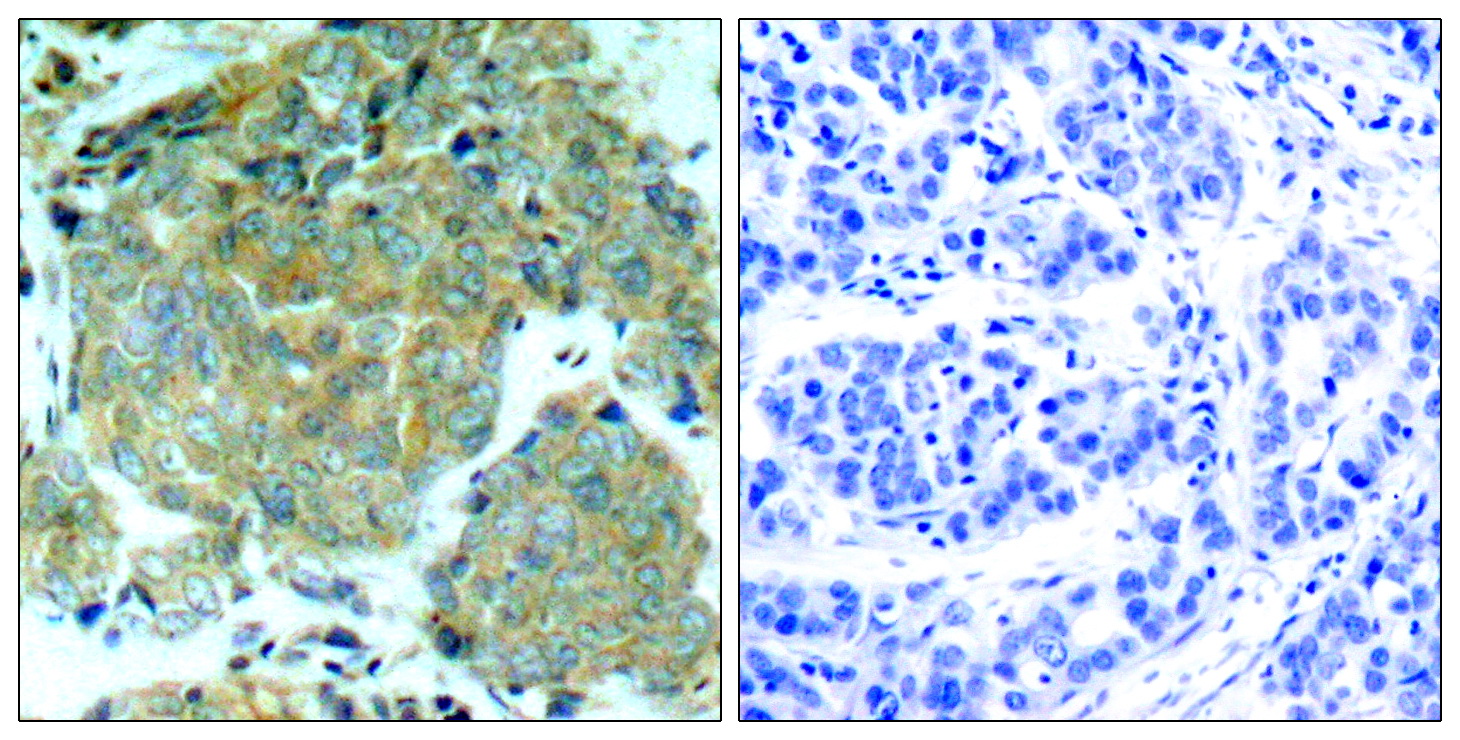 Immunohistochemical analysis of paraffin-embedded human breast carcinoma tissue using eIF2u03b1 (Phospho-Ser51) Antibody (left) or the same antibody preincubated with blocking peptide #51279 (right).