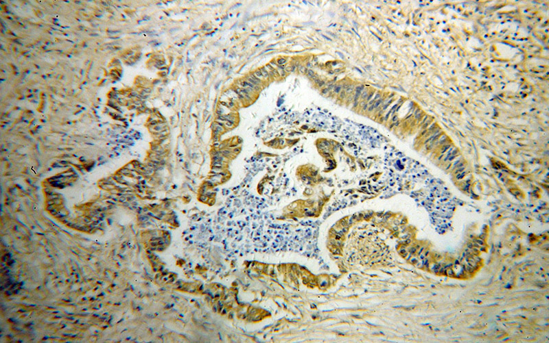 Immunohistochemical of paraffin-embedded human pancreas cancer using Catalog No:110927(GDI2 antibody) at dilution of 1:10 (under 10x lens)