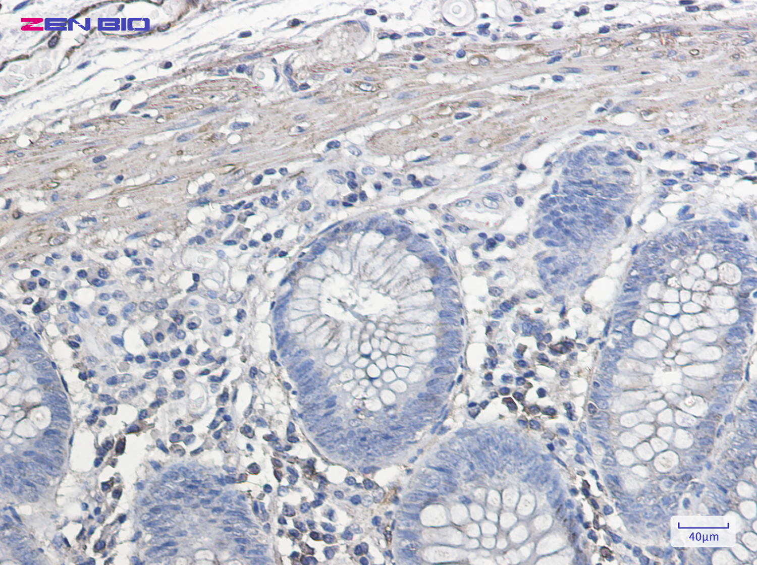 Immunohistochemistry of IL11RA in paraffin-embedded Human colon cancer tissue using IL11RA Rabbit pAb at dilution 1/50