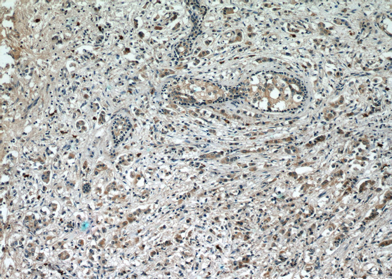 Immunohistochemical of paraffin-embedded human breast cancer using Catalog No:113556(SQSTM1 antibody) at dilution of 1:50 (under 10x lens)