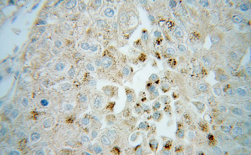 Immunohistochemical of paraffin-embedded human liver cancer using Catalog No:109577(CROT antibody) at dilution of 1:100 (under 40x lens)