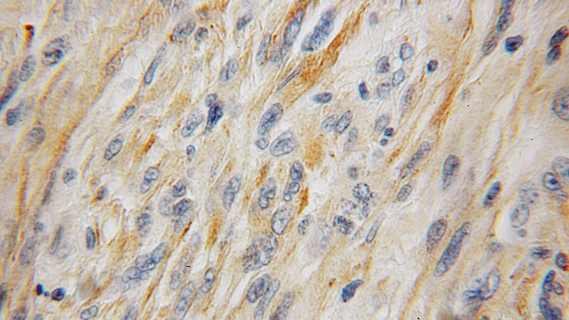 Immunohistochemical of paraffin-embedded human gliomas using Catalog No:111328(HAAO antibody) at dilution of 1:100 (under 10x lens)