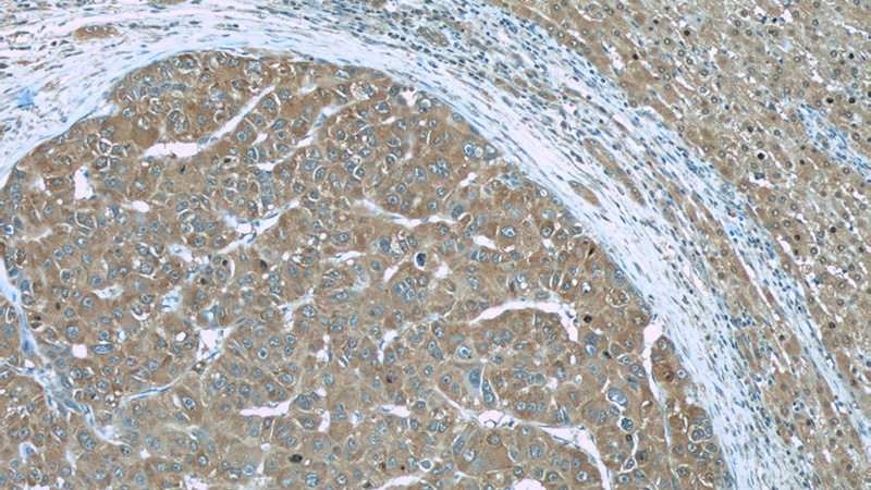 Immunohistochemistry of paraffin-embedded human liver cancer slide using Catalog No:107502(RBP4 Antibody) at dilution of 1:50