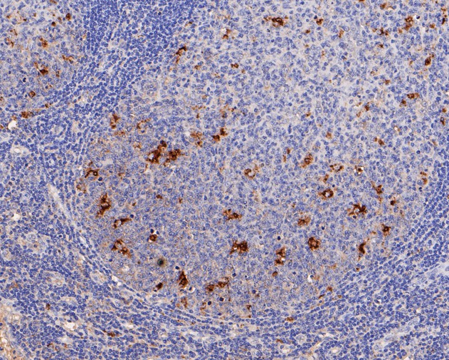 Fig2:; Immunohistochemical analysis of paraffin-embedded human tonsil tissue using anti-CD68 antibody. The section was pre-treated using heat mediated antigen retrieval with Tris-EDTA buffer (pH 8.0-8.4) for 20 minutes.The tissues were blocked in 5% BSA for 30 minutes at room temperature, washed with ddH; 2; O and PBS, and then probed with the primary antibody ( 1/200) for 30 minutes at room temperature. The detection was performed using an HRP conjugated compact polymer system. DAB was used as the chromogen. Tissues were counterstained with hematoxylin and mounted with DPX.