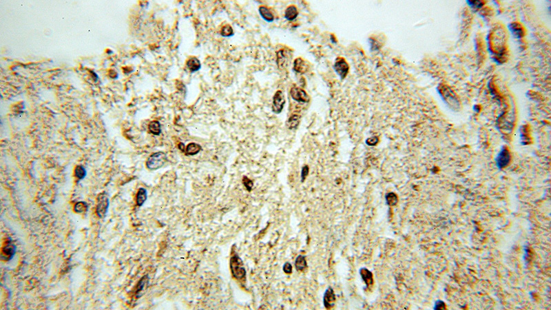 Immunohistochemical of paraffin-embedded human gliomas using Catalog No:116750(HPCA antibody) at dilution of 1:50 (under 10x lens)