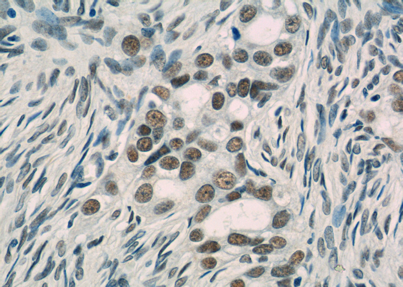 Immunohistochemistry of paraffin-embedded human ovary tumor tissue slide using Catalog No:116012(GTF2I Antibody) at dilution of 1:50 (under 40x lens)
