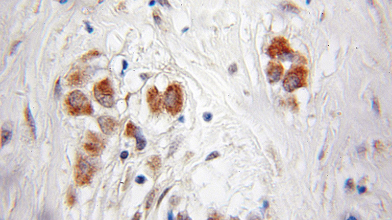 Immunohistochemical of paraffin-embedded human breast cancer using Catalog No:113878(PI4KA antibody) at dilution of 1:50 (under 10x lens)